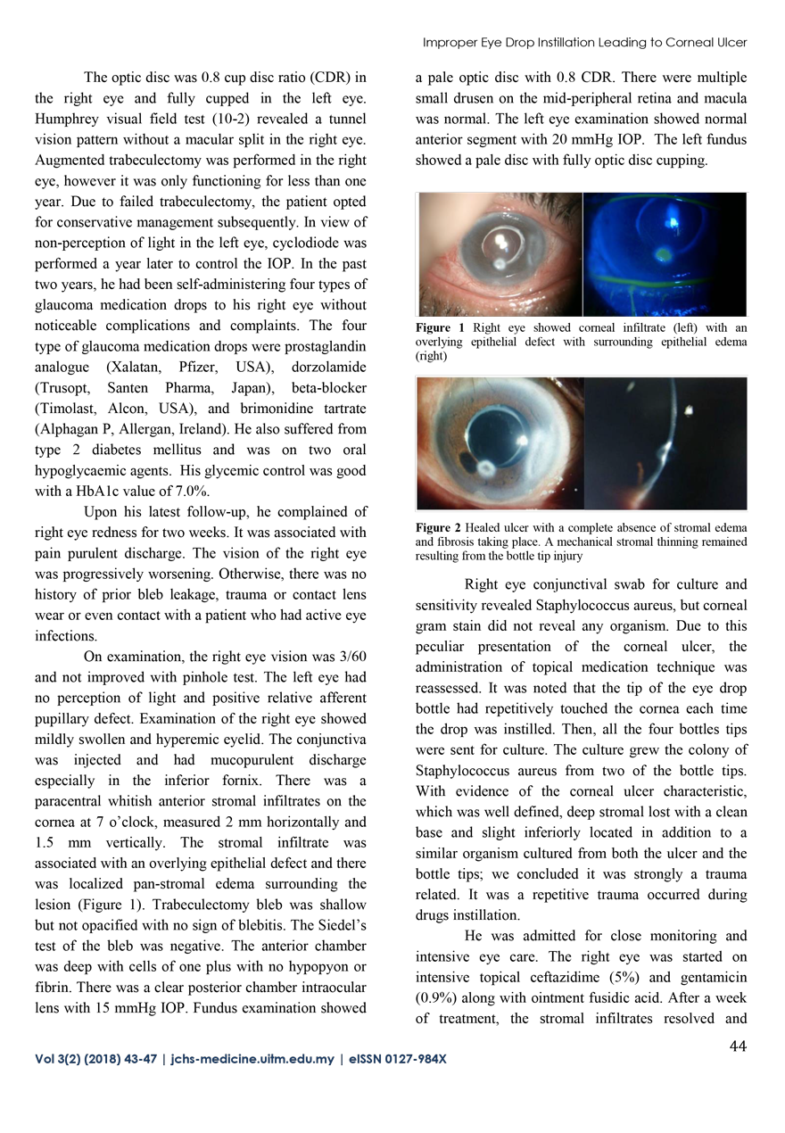 Improper Technique of Eye Drop Instillation Leading to Corneal Ulcer in a Visually Impaired Glaucoma Patient 2